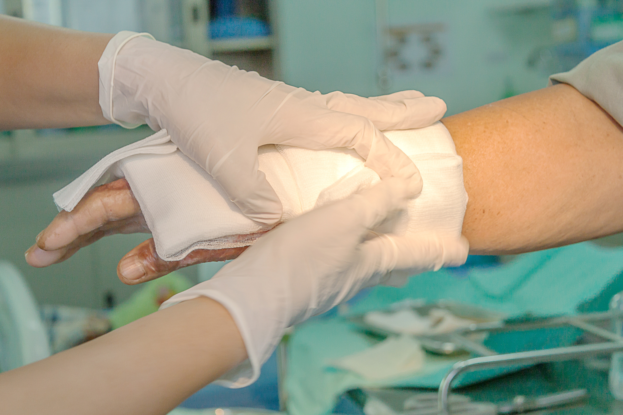 Dressing burned wound